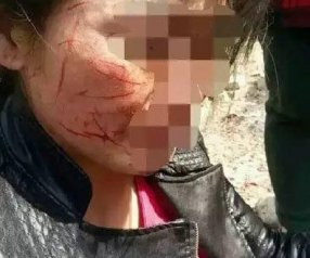 女子脸部被老公和小三划近百刀毁容