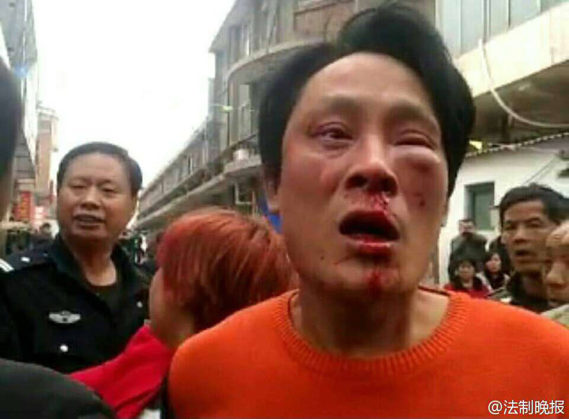 　　冲突发生后，汝州市委、市政府高度重视，要求温泉镇党委、政府全力救治伤员，稳定群众情绪，防止事态扩大。温泉镇党委、政府主要领导及棚改拆迁指挥部工作人员现场对群众进行政策解释和疏散劝离，并对下一步工作做出具体安排：一是安排温泉镇两名副科级干部专门协调汝州市、温泉镇医疗单位，妥善救治受伤人员；二是安排温泉镇派出所第一时间介入，展开调查；三是安排温泉镇班子成员连夜深入当事群众家中座谈，了解群众诉求，进一步做细、做好群众工作。图为现场受伤人员。