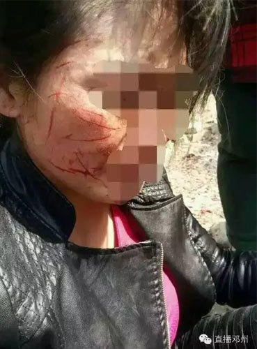　　日前，一组《邓州一女子被老公和小三打成重伤 脸部被划近百刀》的照片在网上和微信上疯传。照片显示，一女子脸部被锐器划伤，惨不忍睹，并晒出丈夫与小三私密照片。记者调查采访发现，这是一起因丈夫在婚姻存续期间，与第三者同居引发的暴力事件。目前，当地警方已介入调查。