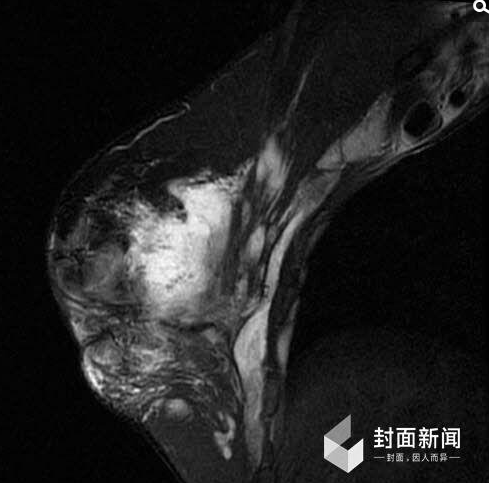 　　没过多久，红粉就感觉到胸部的异常，突如其来的犹如灼烧般的疼痛从此与她相伴，再也不曾消失。除了身体的痛楚外，她还必须忍受精神上的折磨。“我打得太多了，人家打300ml，我打了600ml。我当时是个小女孩，胸部却大得必须买孕妇的胸罩来穿。”在CT片中，她的乳房内依旧分布着大量的白色物质，那就是奥美定。