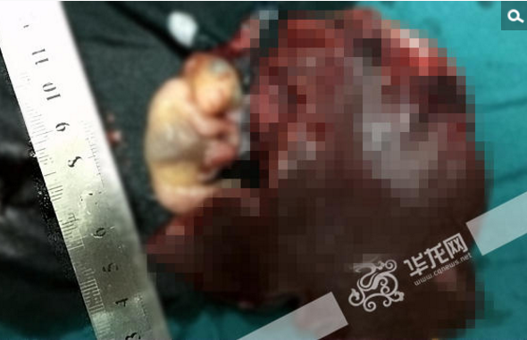 　　医生翻看类似罕见病例的治疗文献时发现，其他医院都是直接通过开腹手术，整个切除脾脏连同胎儿一并取出。“这样的手术对患者伤害太大了，我们想尽可能不把她脾脏切完，并保留脾脏功能。”郑树国教授说。7月15日19时左右，该院肝胆科李建伟、王小军两名副教授操刀手术，经过2小时30分钟时间，将脾脏下极连同胎儿切除。图为取出胎儿时，已跟2到3个月的胎儿差不多大小。