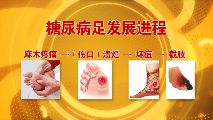 2016年7月26日播出 <wbr>《护好“糖足”不截肢》