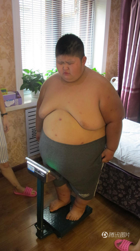 小李航出生时重5斤3两，和正常孩子差不多，从3岁开始，他突然饭量大增，4岁时体重已达86斤。随着时间的推移，小李航的体重直线上升，但是智力却没有正常发展，不仅情绪不稳，而且计算能力差，很多简单的加减法都不会，2012年检测智商提示“精神发育迟滞，社会生活能力低下”。