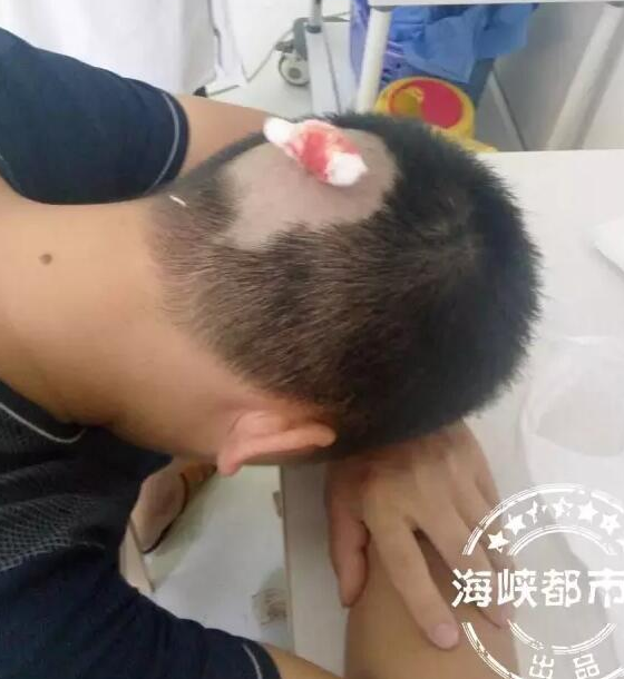 　　张女士用虚弱的声音告诉海都记者，今天上午10时许，她正骑电动车，途径福沁路时，看到园林工人正在修剪道路两旁的行道树。“从23日开始，就有工人在这修剪树枝了。“张女士说，见到这一幕，她也没觉得什么，按照原来上班的路线，一路向前骑去。 而意外突然发生了。张女士突然看到，一根树枝从天而降，横在道路上，随后一群马蜂涌了出来，她赶紧加速离开，但马蜂却追着她跑，蜇到了她的手臂、面部和头顶，“马蜂特别大只，有一截手指长。我随手往头发里一抓，就抓出了一把马蜂。”图为陈先生只好剃掉后面的头发。