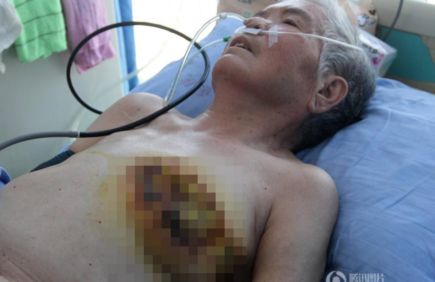 　　“母亲身上的伤是在我弟弟范某奎家生活时出现的，母亲8月11日被我弟弟送到了广饶县人民医院治疗，14日我们把母亲转到了东营继续接受治疗。”在医院陪护老人的女儿范女士告诉记者，她母亲今年76岁，有两儿两女四个孩子，从2015年12月份开始，老人由儿女轮流照顾，由于涉及房产纠纷，弟弟范某奎自今年3月1日接走老人后就拒绝哥哥姐姐轮流照顾，母亲一直住在弟弟弟媳家。