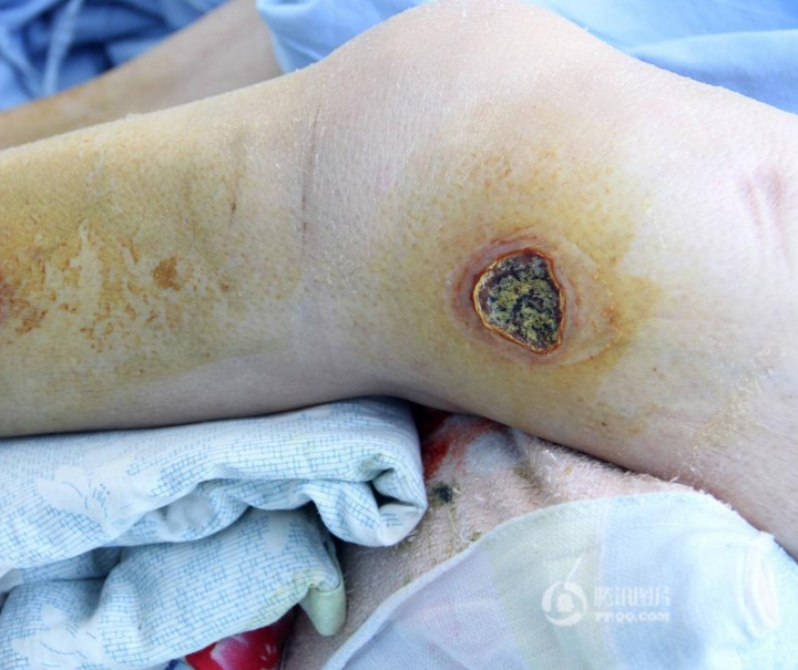 　　记者电话联系了老人的小儿子范某奎，他确认了因为房产同哥哥存在纠纷一事，并表示哥哥姐姐不赡养老人，母亲一直都是由他照顾。对于老人身上的伤疤其表示是褥疮，有医院的病例可以证明，“你可以打听打听，问问周围的邻居我是虐待老人的人吗？”但范拒绝见面沟通，其承诺给记者发送老人在广饶县人民医院治疗的病例也一直没有收到。记者获悉，目前广饶县警方已受理此案，具体情况正在调查当中。