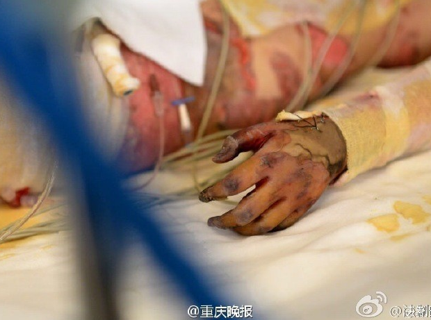 　　目前佳佳妹因为伤势过重，被送往西南医院重症监护室抢救，经诊断她全身79%烧伤，双手面临截肢。