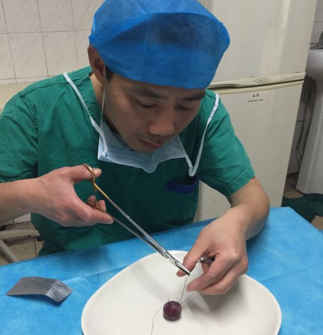 　　周建波说，他用棉签吃饭已经有两年多时间了，从起初的不熟练，一顿饭要花费比平时多一半的时间，到现在不仅用时跟拿筷子差不多，还可以左右开弓，两只手同时用四根棉签夹菜。周建波说，除了用棉签吃饭，平日里，他还会做些针线活，通过穿针引线达到锻炼手指灵活性的目的，这是从大学时期就养成的习惯。现在，不仅自己的扣子掉了、袜子破了洞是他自己缝补，有了儿子以后，小家伙的针线活也归他承包了。图为医生给葡萄缝合。