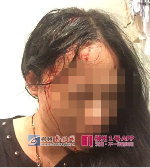 　　其中覃女士命中眉心，情况最严重，还在进行手术抢救，她能说话，头脑清醒，何先生和女儿己脱离危险。目前受伤旅客情绪稳定。